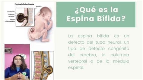 caso clinico espina bifida